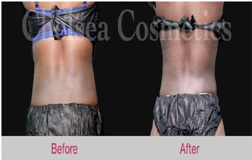 Consider Liposuction For Perfect Contouring