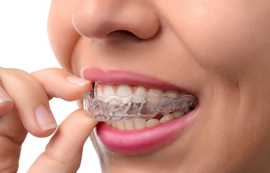 Invisalign And Its Dental Uses