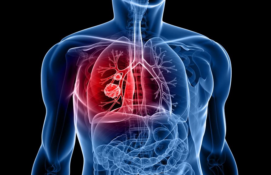 Lung Cancer Prevention. 
